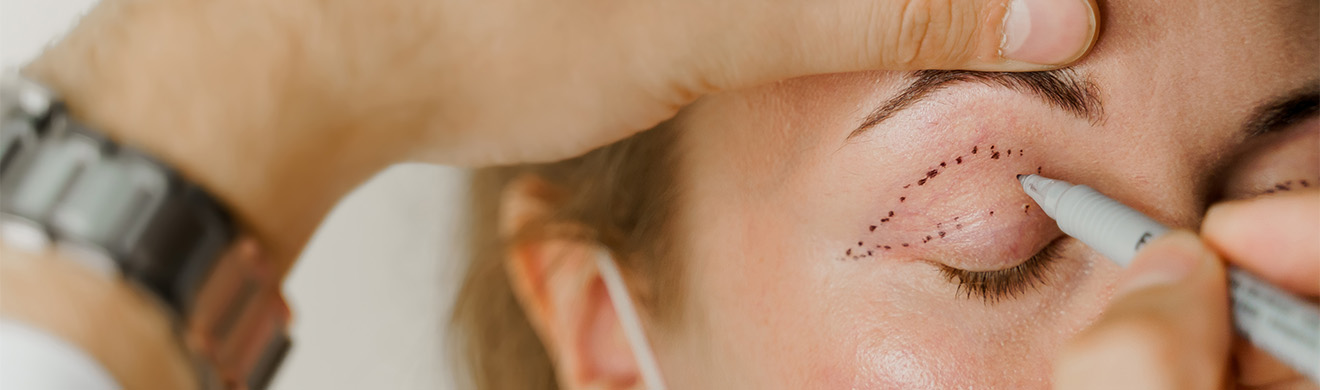 Facharzt markiert das Gesicht einer Patientin vor einer plastisch-ästhetischen Augenlidoperation.